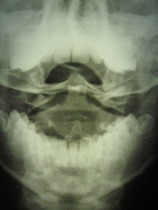 Рентгенограмма подвывиха у взрослого пациента