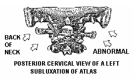 Posterior cervical view of a left subluxation of Atlas